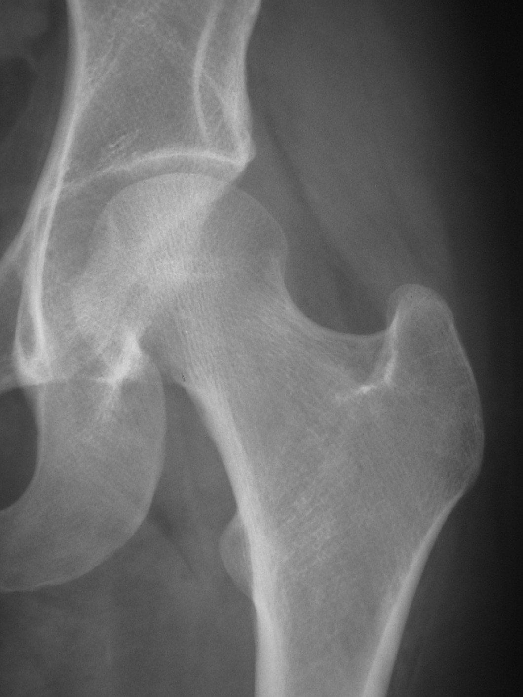 artrosi Radiologia Ortopedica artrosi Radiologia Ortopedica